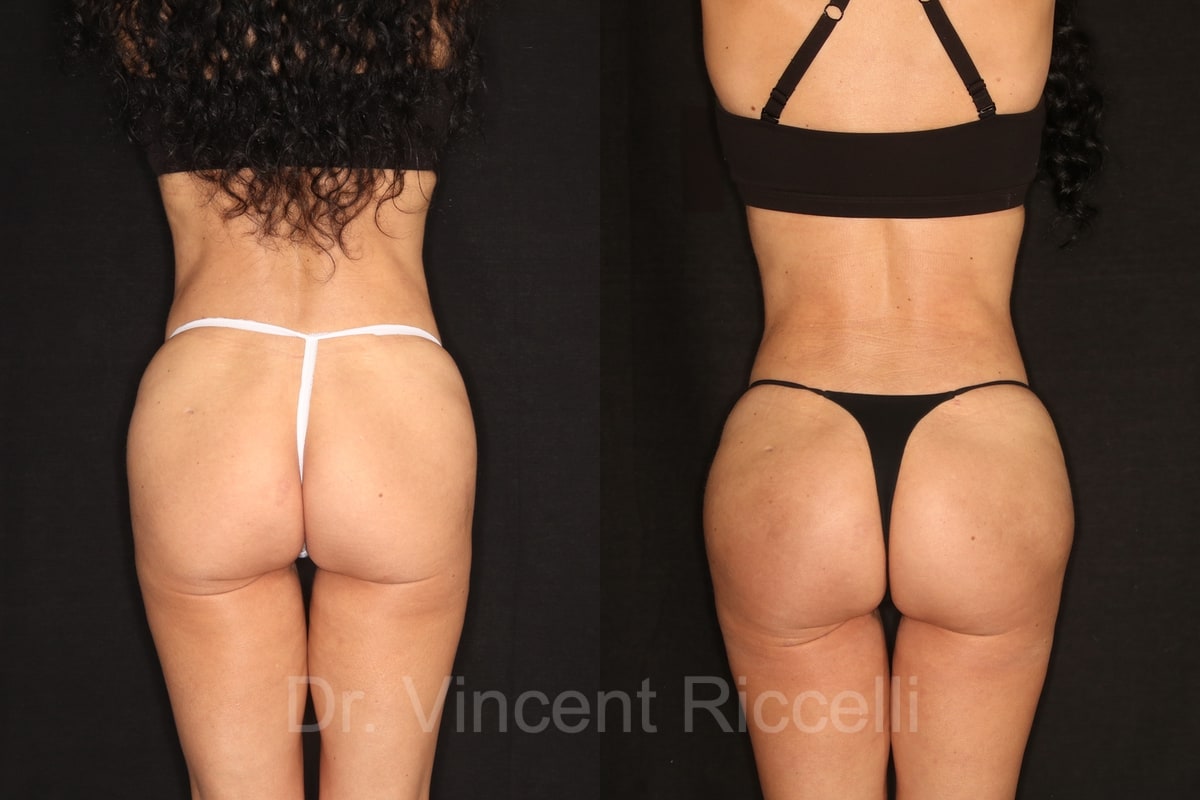 Rear view: before and after mini-abdominoplasty, liposuction 360, and gluteal fat grafting with AlloClae by Dr. Vincent Riccelli.
